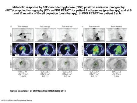 Metabolic response by 18F-fluorodeoxyglucose (FDG) positron emission tomography (PET)/computed tomography (CT). a) FDG PET/CT for patient 2 at baseline.