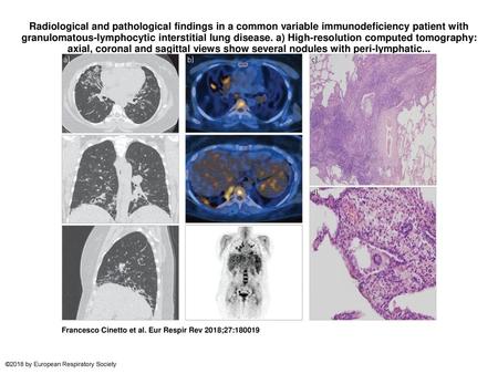 Radiological and pathological findings in a common variable immunodeficiency patient with granulomatous-lymphocytic interstitial lung disease. a) High-resolution.