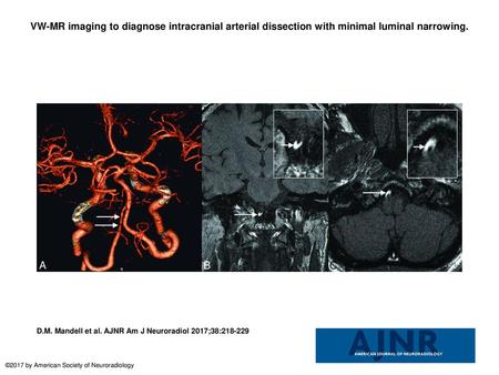 VW-MR imaging to diagnose intracranial arterial dissection with minimal luminal narrowing. VW-MR imaging to diagnose intracranial arterial dissection with.