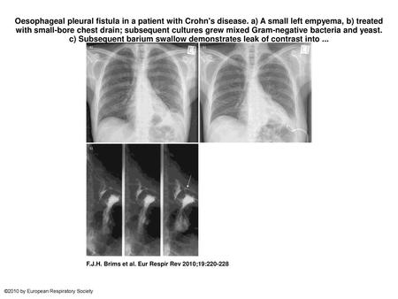 Oesophageal pleural fistula in a patient with Crohn's disease