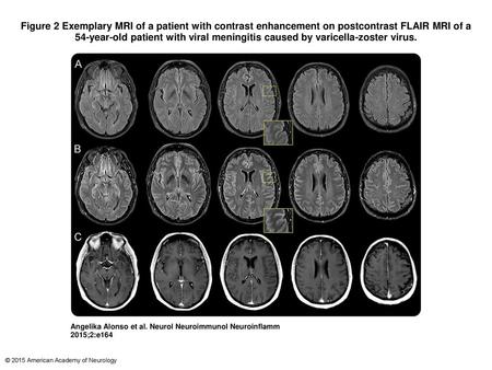 Figure 2 Exemplary MRI of a patient with contrast enhancement on postcontrast FLAIR MRI of a 54-year-old patient with viral meningitis caused by varicella-zoster.