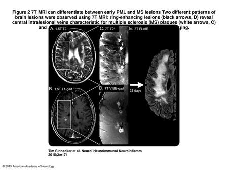 Figure 2 7T MRI can differentiate between early PML and MS lesions Two different patterns of brain lesions were observed using 7T MRI: ring-enhancing lesions.