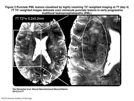 Figure 3 Punctate PML lesions visualized by highly resolving T2