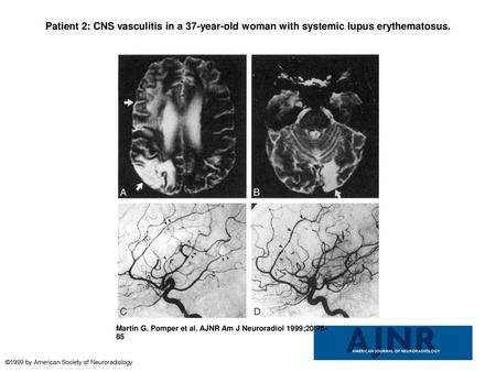 Patient 2: CNS vasculitis in a 37-year-old woman with systemic lupus erythematosus. Patient 2: CNS vasculitis in a 37-year-old woman with systemic lupus.