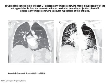 A) Coronal reconstruction of chest CT angiography images showing marked hypodensity of the left upper lobe. b) Coronal reconstruction of maximum intensity.