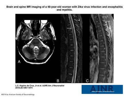 Brain and spine MR imaging of a 48-year-old woman with Zika virus infection and encephalitis and myelitis. Brain and spine MR imaging of a 48-year-old.