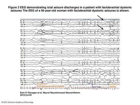 Figure 3 EEG demonstrating ictal seizure discharges in a patient with faciobrachial dystonic seizures The EEG of a 56-year-old woman with faciobrachial.