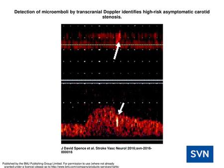 Detection of microemboli by transcranial Doppler identifies high-risk asymptomatic carotid stenosis. Detection of microemboli by transcranial Doppler identifies.