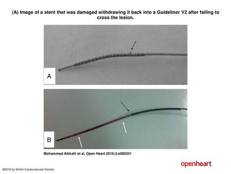 (A) Image of a stent that was damaged withdrawing it back into a Guideliner V2 after failing to cross the lesion. (A) Image of a stent that was damaged.