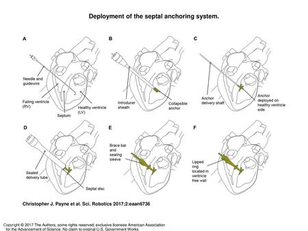 Deployment of the septal anchoring system.