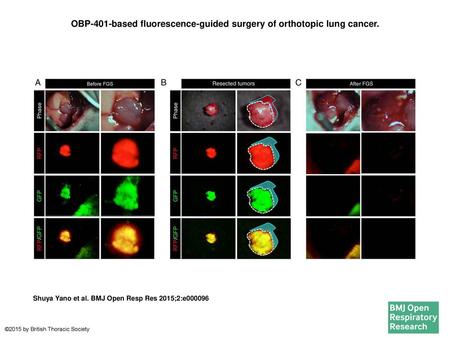 OBP-401-based fluorescence-guided surgery of orthotopic lung cancer.