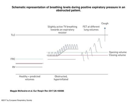 Schematic representation of breathing levels during positive expiratory pressure in an obstructed patient. Schematic representation of breathing levels.