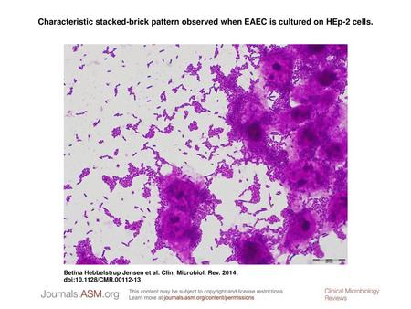 Characteristic stacked-brick pattern observed when EAEC is cultured on HEp-2 cells. Characteristic stacked-brick pattern observed when EAEC is cultured.