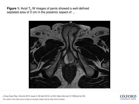Figure 1: Axial T2 W images of penis showed a well-defined septated area of 2 cm in the posterior aspect of ... Figure 1: Axial T2 W images.