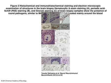 Figure 2 Histochemical and immunohistochemical staining and electron microscopic examination of structures in the brain biopsy Hematoxylin & eosin staining.