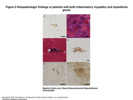 Figure 2 Histopathologic findings of patients with both inflammatory myopathy and myasthenia gravis Histopathologic findings of patients with both inflammatory.