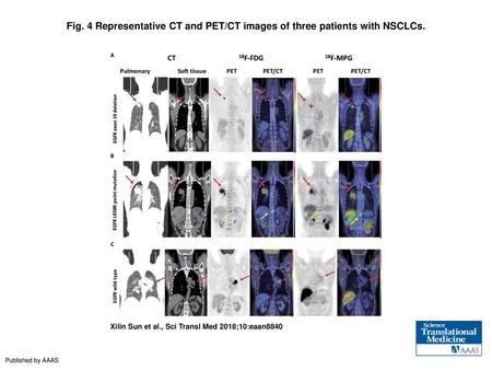 Representative CT and PET/CT images of three patients with NSCLCs