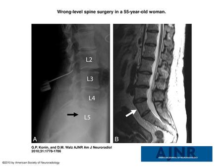 Wrong-level spine surgery in a 55-year-old woman.