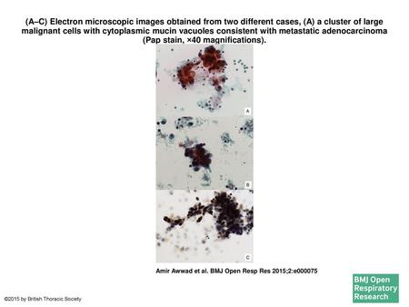 (A–C) Electron microscopic images obtained from two different cases, (A) a cluster of large malignant cells with cytoplasmic mucin vacuoles consistent.