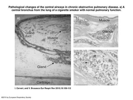 Pathological changes of the central airways in chronic obstructive pulmonary disease. a) A central bronchus from the lung of a cigarette smoker with normal.