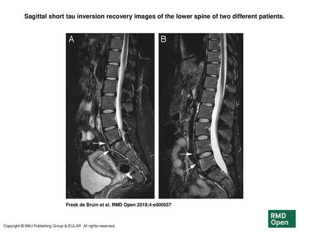 Sagittal short tau inversion recovery images of the lower spine of two different patients. Sagittal short tau inversion recovery images of the lower spine.