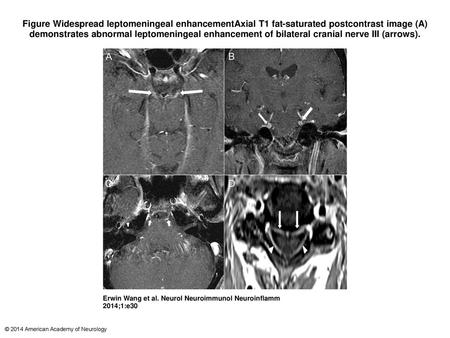 Figure Widespread leptomeningeal enhancementAxial T1 fat-saturated postcontrast image (A) demonstrates abnormal leptomeningeal enhancement of bilateral.