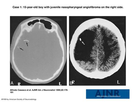 Case 1: 15-year-old boy with juvenile nasopharyngeal angiofibroma on the right side. Case 1: 15-year-old boy with juvenile nasopharyngeal angiofibroma.