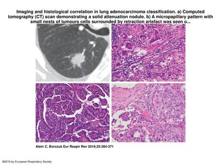 Imaging and histological correlation in lung adenocarcinoma classification. a) Computed tomography (CT) scan demonstrating a solid attenuation nodule.