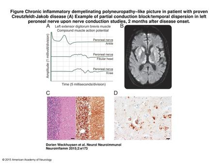 Figure Chronic inflammatory demyelinating polyneuropathy–like picture in patient with proven Creutzfeldt-Jakob disease (A) Example of partial conduction.