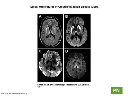 Typical MRI features of Creutzfeldt-Jakob disease (CJD).