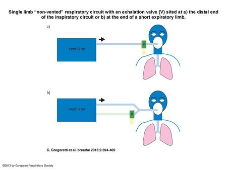 Single limb “non-vented” respiratory circuit with an exhalation valve (V) sited at a) the distal end of the inspiratory circuit or b) at the end of a short.