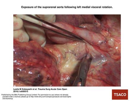 Exposure of the suprarenal aorta following left medial visceral rotation. Exposure of the suprarenal aorta following left medial visceral rotation. Note.