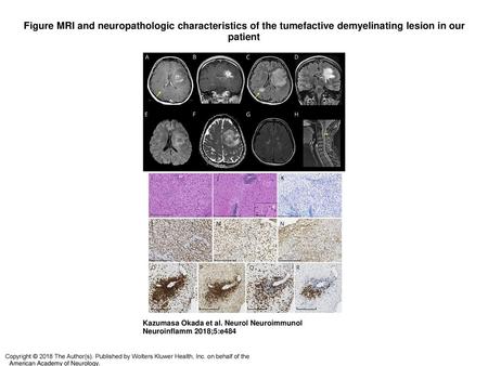 Figure MRI and neuropathologic characteristics of the tumefactive demyelinating lesion in our patient MRI and neuropathologic characteristics of the tumefactive.