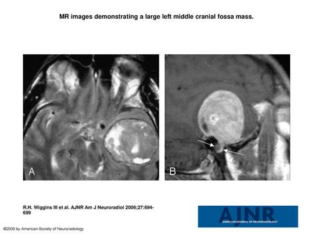 MR images demonstrating a large left middle cranial fossa mass.