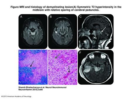 Figure MRI and histology of demyelinating lesion(A) Symmetric T2 hyperintensity in the midbrain with relative sparing of cerebral peduncles. MRI and histology.