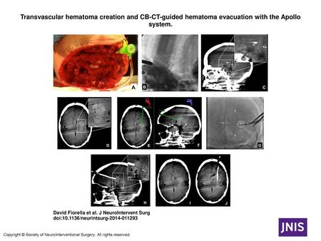 Transvascular hematoma creation and CB-CT-guided hematoma evacuation with the Apollo system. Transvascular hematoma creation and CB-CT-guided hematoma.