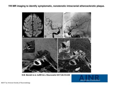 VW-MR imaging to identify symptomatic, nonstenotic intracranial atherosclerotic plaque. VW-MR imaging to identify symptomatic, nonstenotic intracranial.