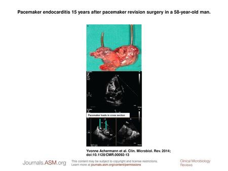 Pacemaker endocarditis 15 years after pacemaker revision surgery in a 58-year-old man. Pacemaker endocarditis 15 years after pacemaker revision surgery.