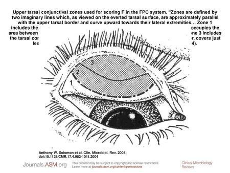 Upper tarsal conjunctival zones used for scoring F in the FPC system
