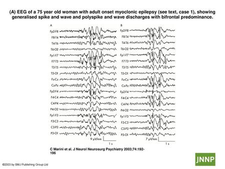 (A) EEG of a 75 year old woman with adult onset myoclonic epilepsy (see text, case 1), showing generalised spike and wave and polyspike and wave discharges.