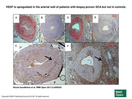 VEGF is upregulated in the arterial wall of patients with biopsy-proven GCA but not in controls. VEGF is upregulated in the arterial wall of patients with.