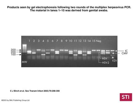 Products seen by gel electrophoresis following two rounds of the multiplex herpesvirus PCR. The material in lanes 1–15 was derived from genital swabs.