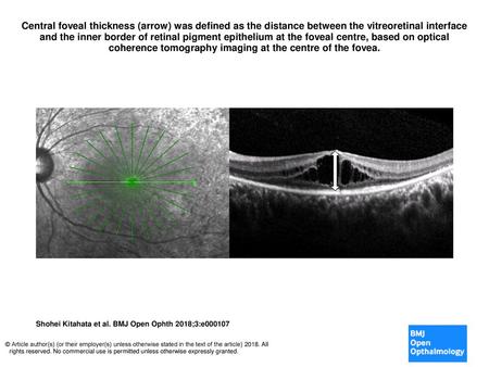 Central foveal thickness (arrow) was defined as the distance between the vitreoretinal interface and the inner border of retinal pigment epithelium at.