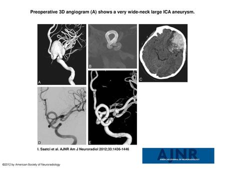 Preoperative 3D angiogram (A) shows a very wide-neck large ICA aneurysm. Preoperative 3D angiogram (A) shows a very wide-neck large ICA aneurysm. It could.