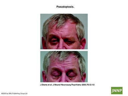  Pseudoptosis.  Pseudoptosis. This man presented with photophobia and difficulty elevating the right side of his forehead. The photograph shows his normal.