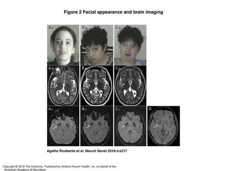Figure 2 Facial appearance and brain imaging