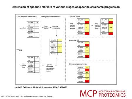 Expression of apocrine markers at various stages of apocrine carcinoma progression. Expression of apocrine markers at various stages of apocrine carcinoma.