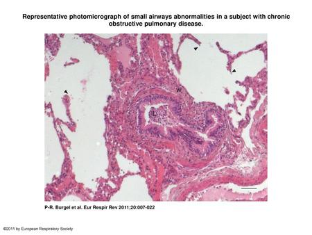 Representative photomicrograph of small airways abnormalities in a subject with chronic obstructive pulmonary disease. Representative photomicrograph of.