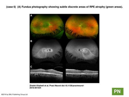 (case 6)  (A) Fundus photography showing subtle discrete areas of RPE atrophy (green areas). (case 6)  (A) Fundus photography showing subtle discrete areas.