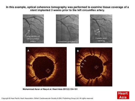 In this example, optical coherence tomography was performed to examine tissue coverage of a stent implanted 3 weeks prior to the left circumflex artery.